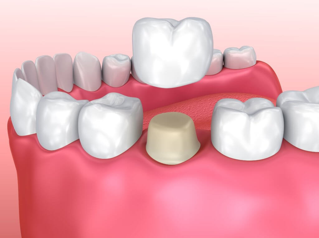 A graphic illustration of a prepped tooth being fitted with a dental crown