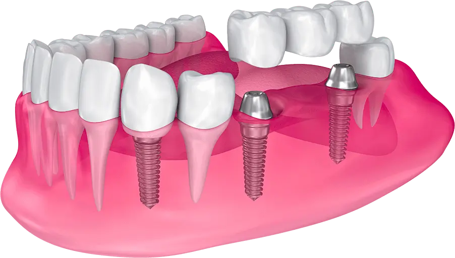An illustrated representation of implants in a jaw with implants and two types of synthetic teeth filling the gaps.