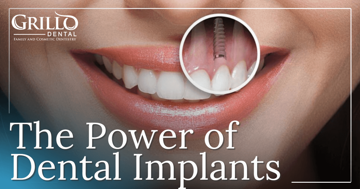 Featured image for “The Tooth Replacement That Behaves Like a Real Tooth”